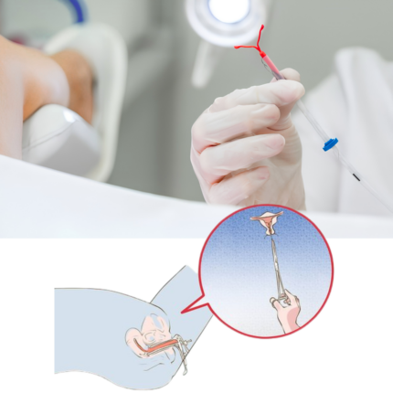 Retiro de Dispositivo Intrauterino (DIU) a domicilio
